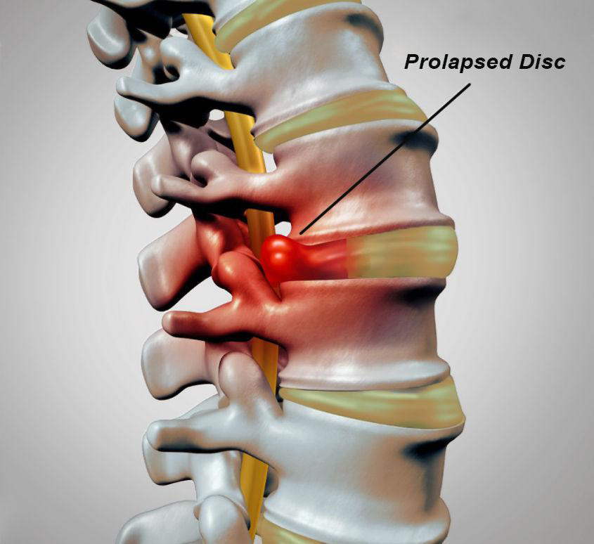 Understanding Disc Prolapse