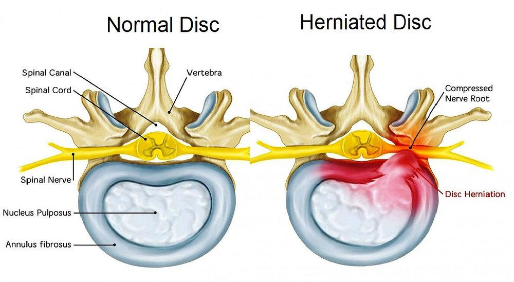 Normal Disc Herniated Disc