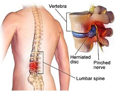 Vertebra and Lumbar spine