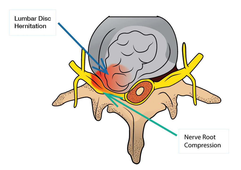 Nerve root compression