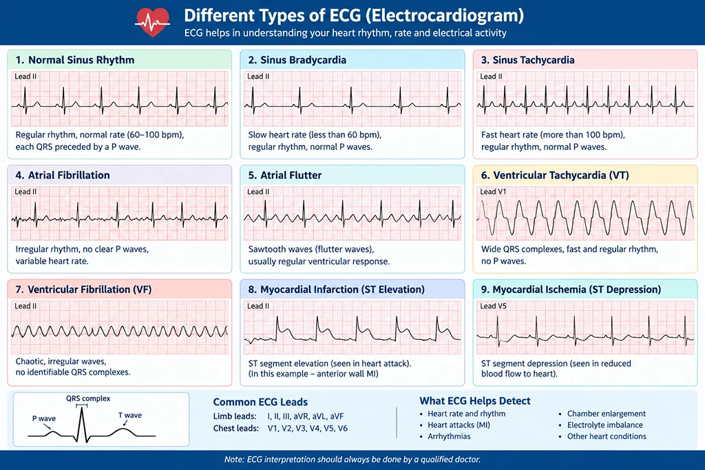 Different types of ECG Electrocardiogram